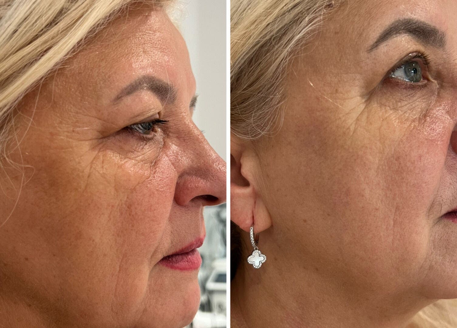 Before-and-after skin treatment at Dotyk Beauty Therapy, London, England, GB, showcasing visible facial rejuvenation.