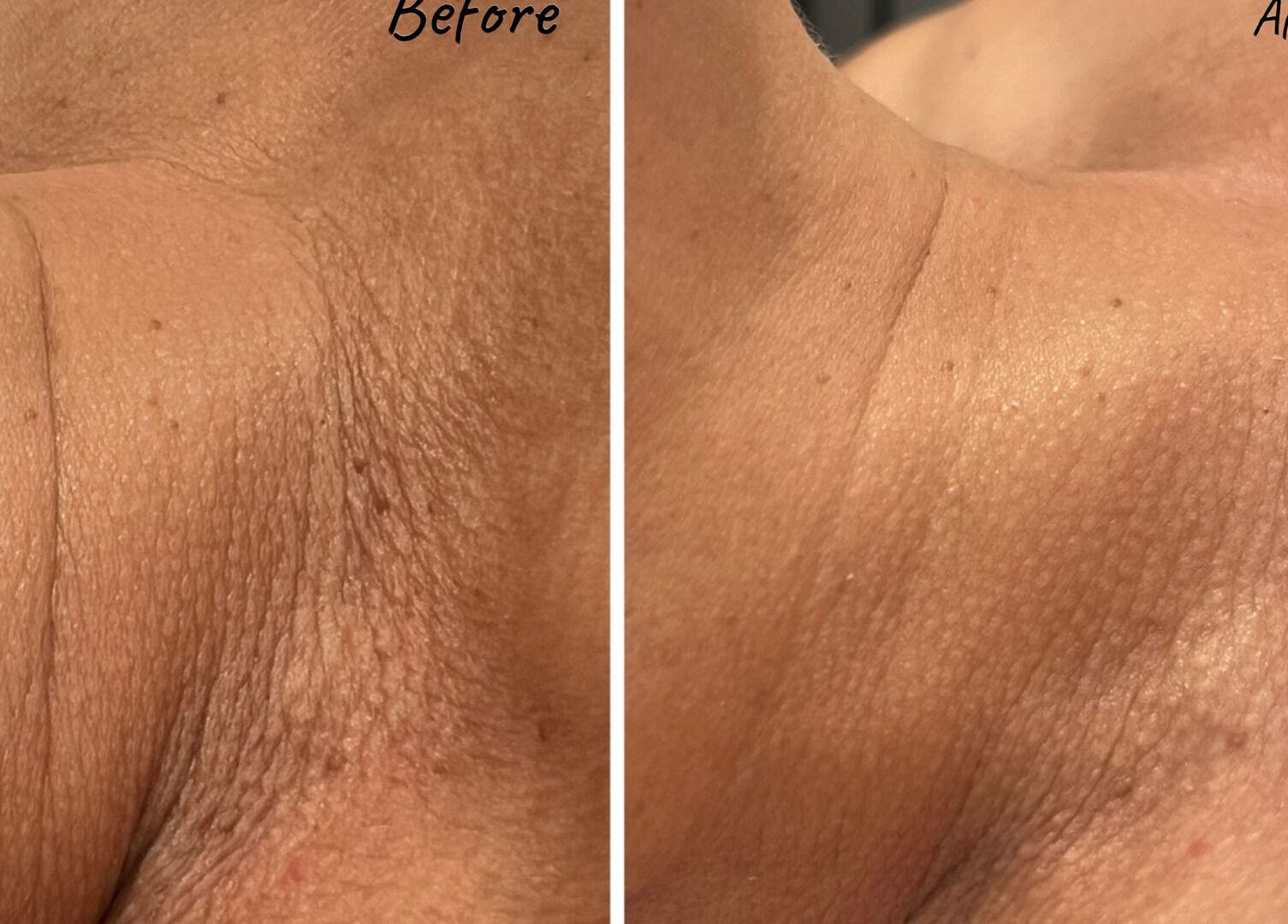 Before and after neck treatment at Dotyk Beauty Therapy in London, England, GB showcasing skin rejuvenation.