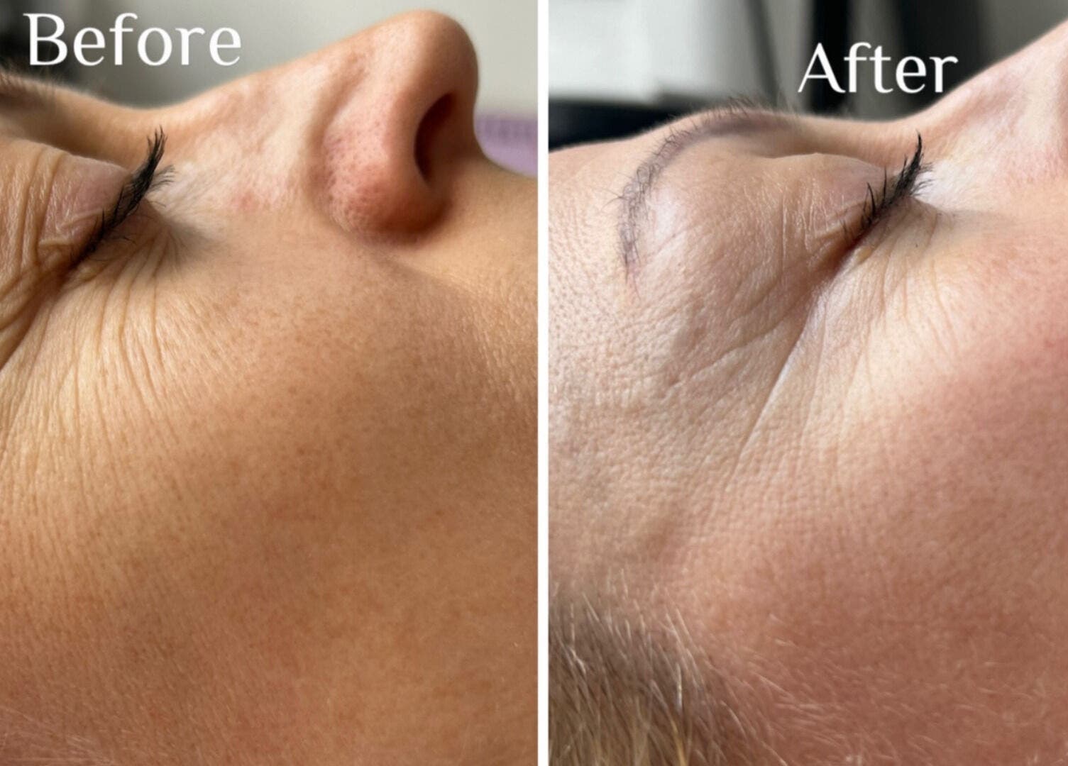 Before and after facial treatment at Dotyk Beauty Therapy in London, England, GB showing skin rejuvenation.