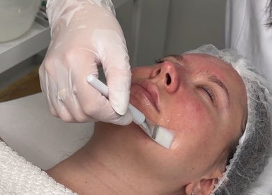 Facial treatment in progress at Nova Touch Clinic, Edgware, England, GB, showcasing precision skincare application.