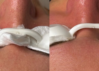 Facial treatment at Tynaesthetics_ in London, England, GB showing improved skin texture and glow.