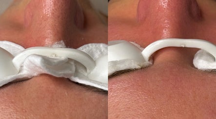 Facial treatment at Tynaesthetics_ in London, England, GB showing improved skin texture and glow.
