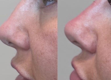 Before and after rhinoplasty at themaedclub, Swallownest, England, GB. Side profiles demonstrate nose refinement.