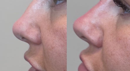 Before and after rhinoplasty at themaedclub, Swallownest, England, GB. Side profiles demonstrate nose refinement.