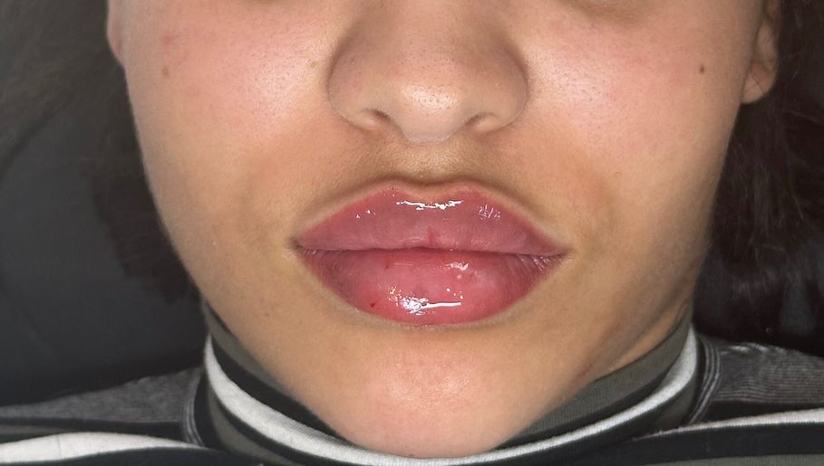Close-up of glossy lips after treatment at Milèro Aesthetics, Sheffield, England, GB.