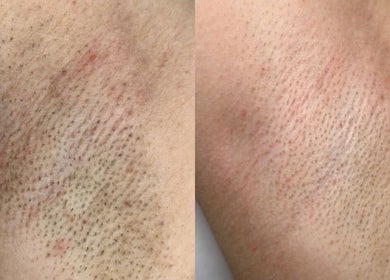 Efekty depilacji laserowej w GABINET MASAŻU I DEPILACJI LASEROWEJ by ALONA KHVOSTENKO w Gdańsku, Województwo Pomorskie, PL.