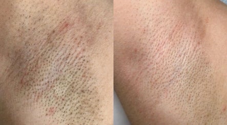 Efekty depilacji laserowej w GABINET MASAŻU I DEPILACJI LASEROWEJ by ALONA KHVOSTENKO w Gdańsku, Województwo Pomorskie, PL.