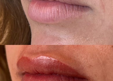 Before and after lip enhancement at Clinic E, Clarkston, Scotland, GB showcasing natural beauty improvement.
