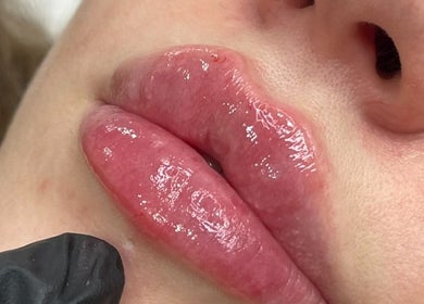 Plump lips after treatment at SADE Aesthetics Berkshire, Reading, England, GB. Glossy and rejuvenated appearance.