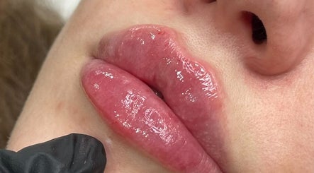 Plump lips after treatment at SADE Aesthetics Berkshire, Reading, England, GB. Glossy and rejuvenated appearance.