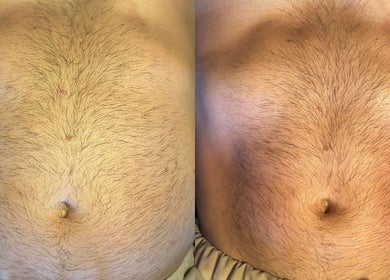 Before and after body treatment at Aura beauty @ 68 Nail & Spa, London, England, GB.