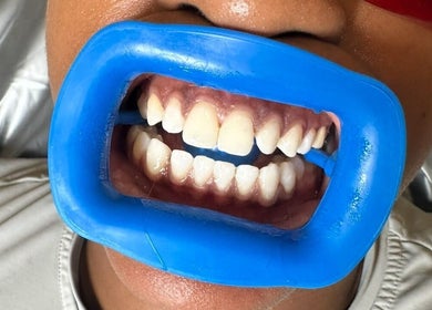 Teeth whitening preparation at Aura beauty - Norbury, London, England, GB with mouth guard in place.