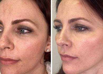 Before and after facial treatment at Bamber Aesthetic Solutions, Slyne, England, GB showing smoother skin.
