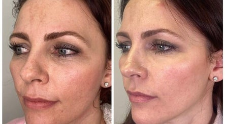 Before and after facial treatment at Bamber Aesthetic Solutions, Slyne, England, GB showing smoother skin.