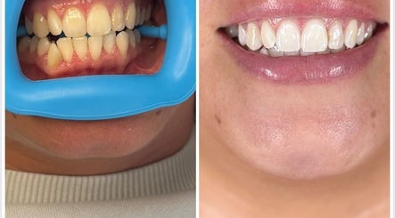 Teeth Whitening by Jazmin image 2
