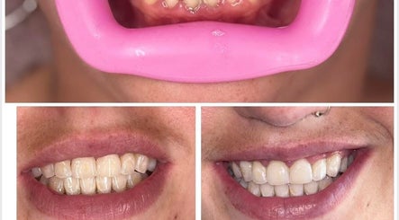 Teeth Whitening by Jazmin image 3