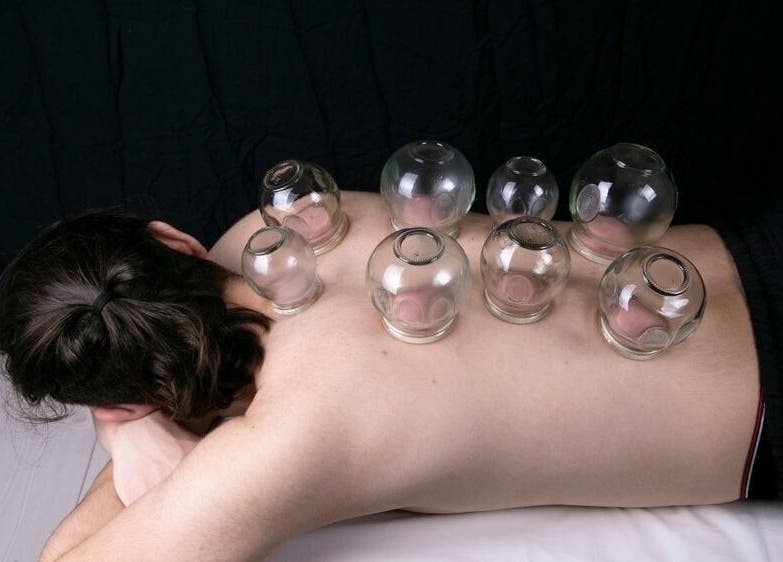 Cupping therapy at Fusion Elite Performance Therapy in Aylesbury, England, GB for wellness and relaxation.