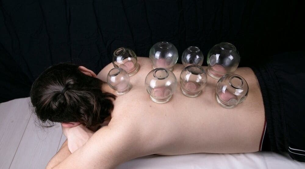 Cupping therapy at Fusion Elite Performance Therapy in Aylesbury, England, GB for wellness and relaxation.