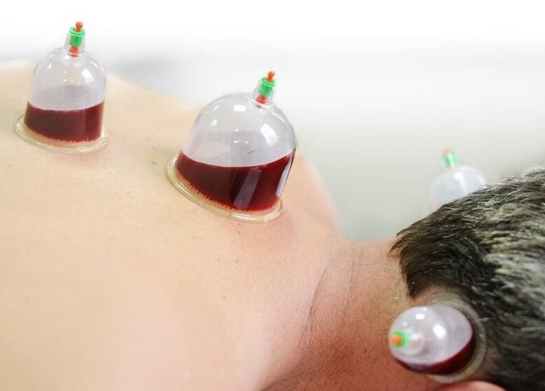 Cupping therapy session at Fusion Elite Performance Therapy, Aylesbury, England, GB for rejuvenation.