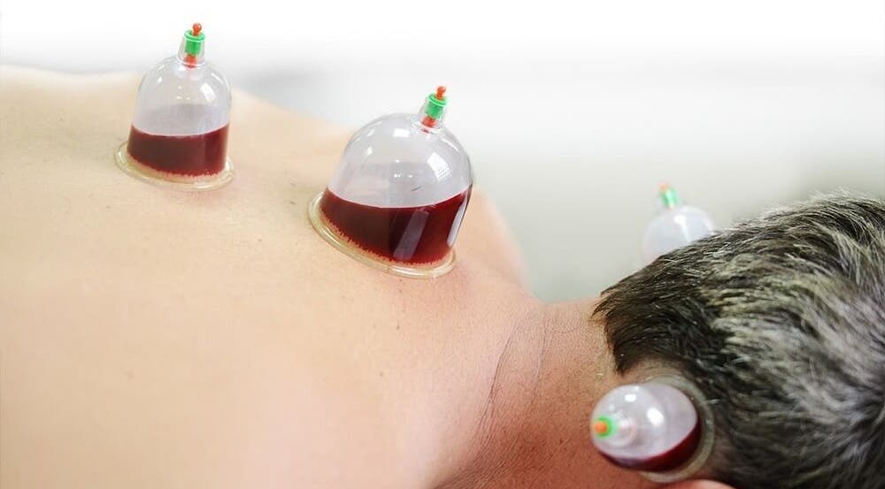 Cupping therapy session at Fusion Elite Performance Therapy, Aylesbury, England, GB for rejuvenation.