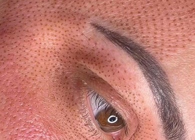 Close-up of plasma skin treatment at NC Beauty Bar, LLC, Milwaukee, Wisconsin, US, showcasing rejuvenated smooth skin.