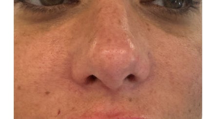 Close-up view of smooth skin treatment at Gorgeous Gate Aesthetics, Burgess Hill, England, GB.