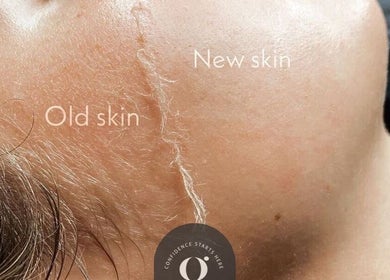 Close-up of skin rejuvenation at Gigi's Skin Lab (inside Lumóra), Sheffield, England, GB showing old and new skin.