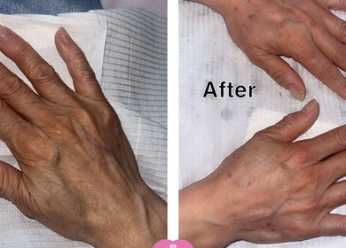 Before and after hand treatment at Lilette Aesthetic Clinic, London, England, GB shows rejuvenated skin.