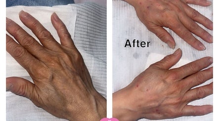 Before and after hand treatment at Lilette Aesthetic Clinic, London, England, GB shows rejuvenated skin.