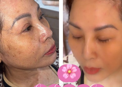 Before and after facial treatment at Lilette Aesthetic Clinic, London, England, GB, showing clearer and smoother skin.