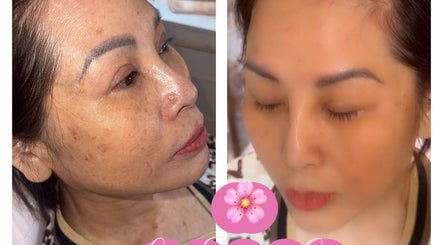 Before and after facial treatment at Lilette Aesthetic Clinic, London, England, GB, showing clearer and smoother skin.