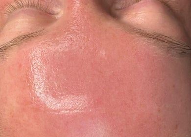 Close-up of a smooth, shiny forehead after treatment at Victoria Concept Beauty Academy, Prescot, England, GB.