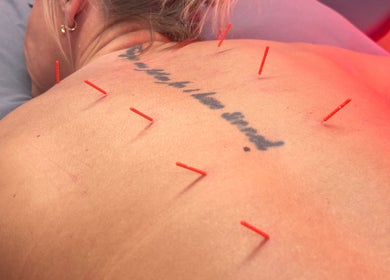 Acupuncture session at Chloe Corden Health, Newark, England, GB, featuring red needles on a client's back.