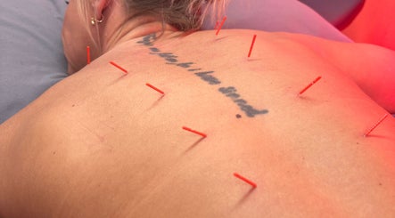 Acupuncture session at Chloe Corden Health, Newark, England, GB, featuring red needles on a client's back.