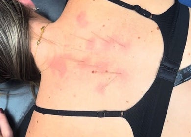 Back acupuncture session at Chloe Corden Health, Newark, England, GB, illustrating wellness therapy.