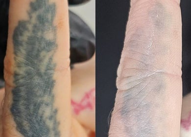 Tattoo removal progress at NuSkinnovation Dainfern Pty Ltd, Sandton, Gauteng, ZA, showing before and after results.