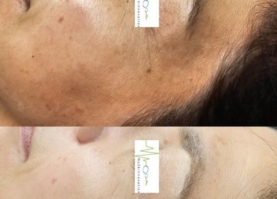 Before and after skin treatment at NuSkinnovation Dainfern Pty Ltd, Sandton, Gauteng, ZA.