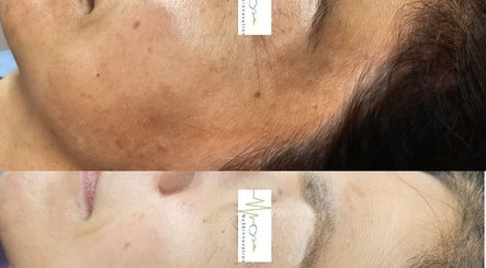 Before and after skin treatment at NuSkinnovation Dainfern Pty Ltd, Sandton, Gauteng, ZA.
