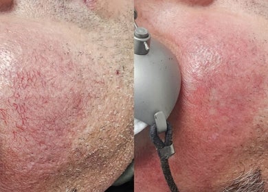 Facial rejuvenation treatment at NuSkinnovation Dainfern Pty Ltd in Sandton, Gauteng, ZA, showing improved skin texture.