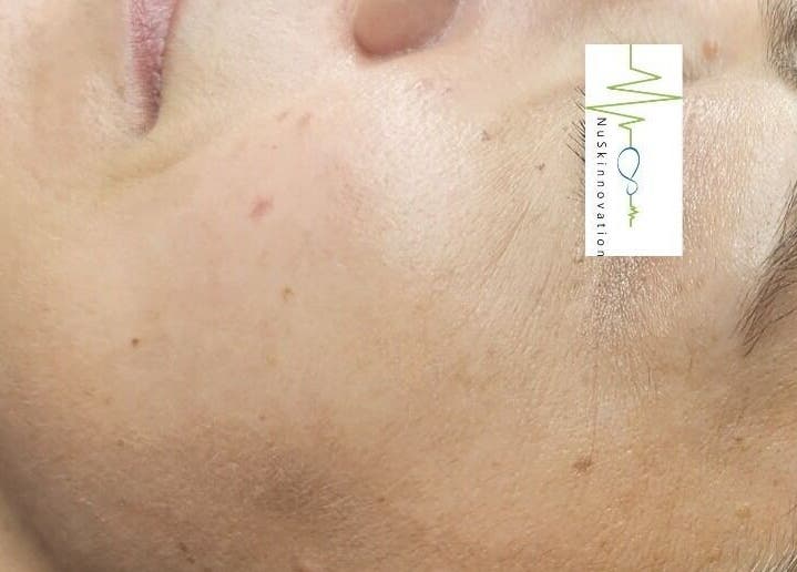 Close-up of smooth skin post-treatment at NuSkinnovation Dainfern Pty Ltd, Sandton, Gauteng, ZA.