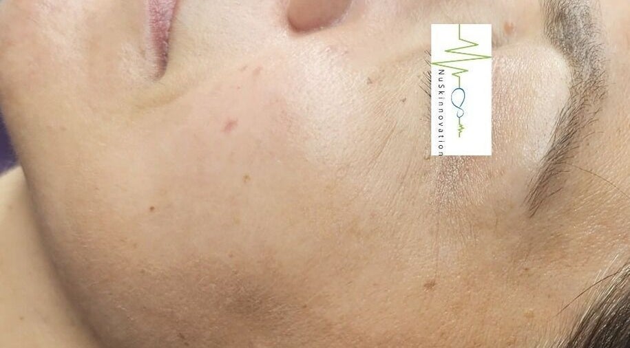 Close-up of smooth skin post-treatment at NuSkinnovation Dainfern Pty Ltd, Sandton, Gauteng, ZA.
