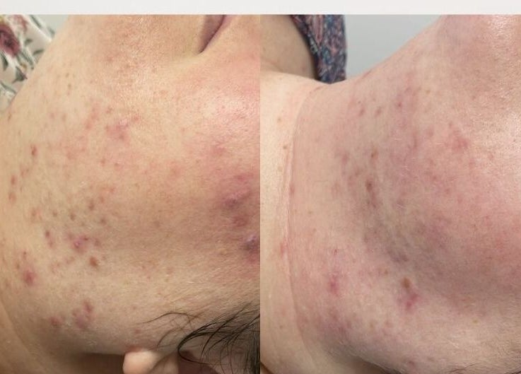 Before and after skin treatment at NuSkinnovation Dainfern Pty Ltd, Sandton, Gauteng, ZA, showcasing visible results.