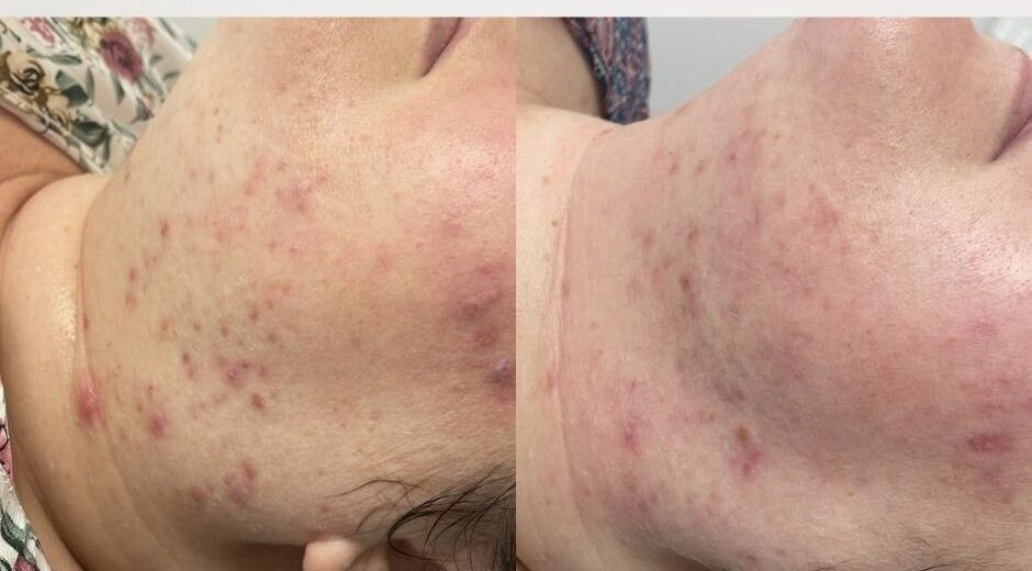 Before and after skin treatment at NuSkinnovation Dainfern Pty Ltd, Sandton, Gauteng, ZA, showcasing visible results.