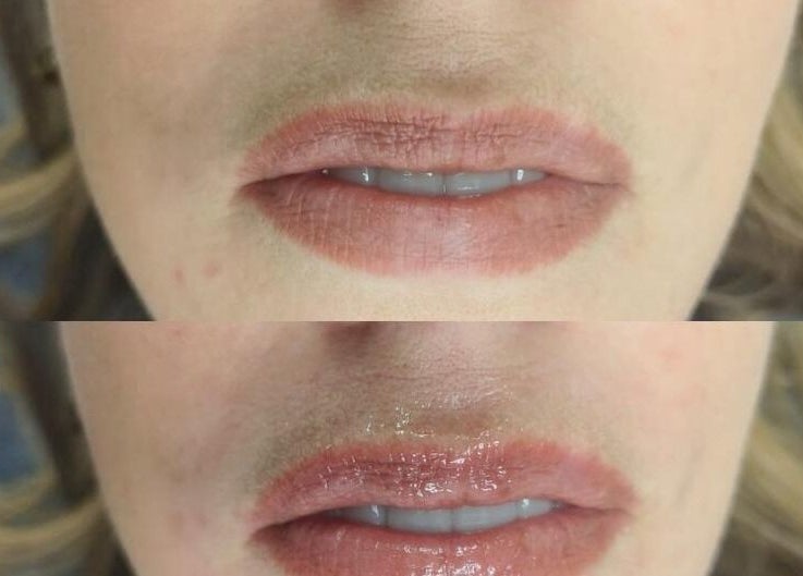 Before and after lip enhancement at NuSkinnovation Dainfern Pty Ltd, Sandton, Gauteng, ZA.