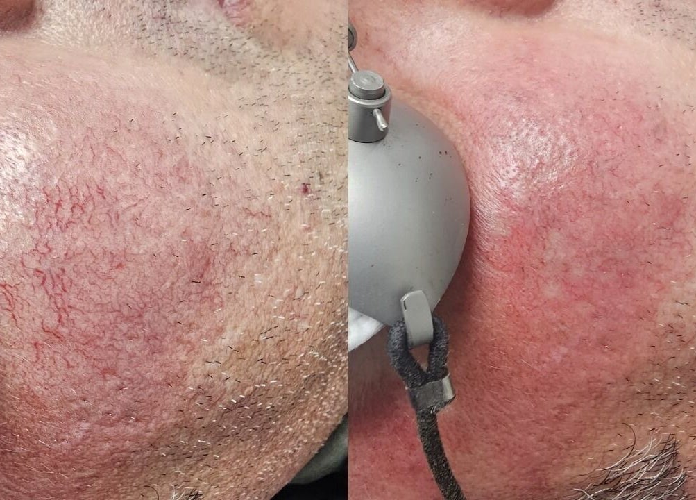 Close-up of facial treatment at NuSkinnovation Dainfern Pty Ltd in Sandton, Gauteng, ZA showcasing skin rejuvenation.