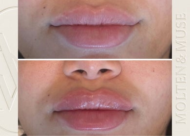 Before and after lip enhancement at Molten&Muse, Hatfield, England, GB showcasing rejuvenated lips.
