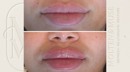 Before and after lip enhancement at Molten&Muse, Hatfield, England, GB showcasing rejuvenated lips.
