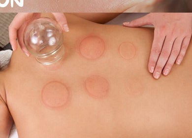 Cupping therapy at Therapeutic Massage by Kelly Murphy, Dallas, Pennsylvania, US enhances relaxation and healing.