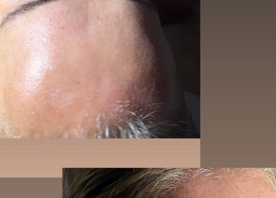 Tratamiento facial en Camila beauty spa, CW, mostrando piel lisa y brillante.