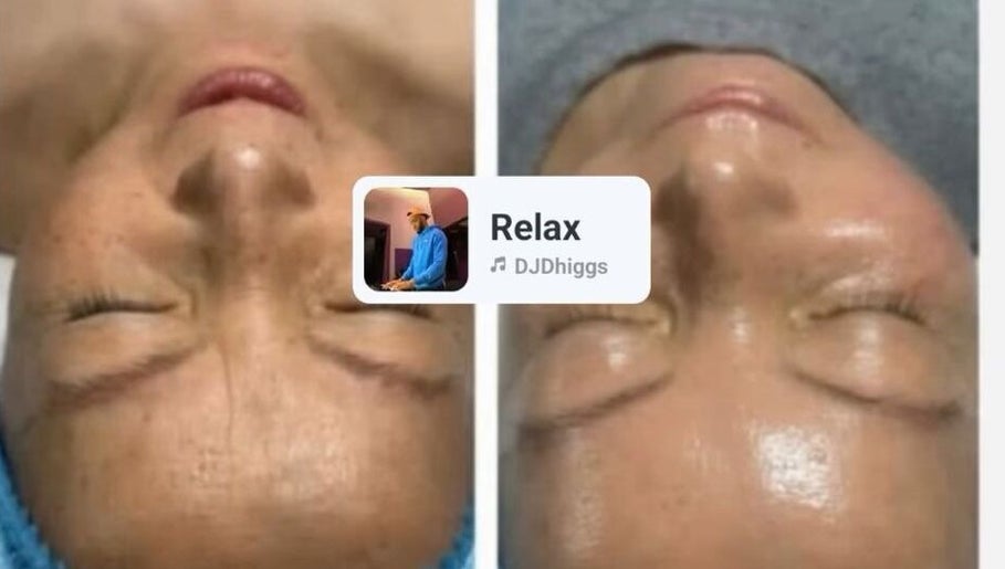 Before and after facial treatment at CKB SKIN CLINIC, Glasgow, Scotland, GB showing smoother skin results.